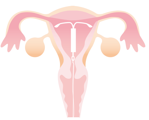 子宮内避妊具（IUD）／子宮内避妊システム（IUS）