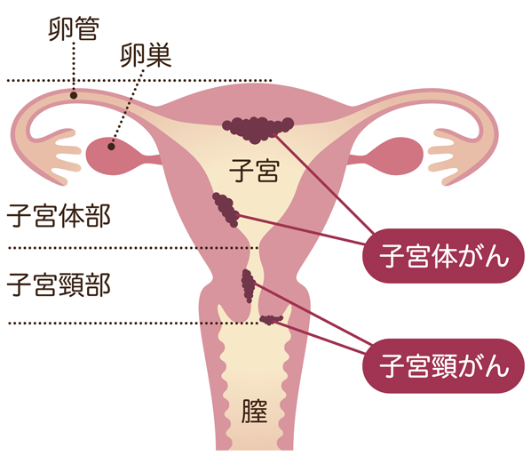 子宮がん