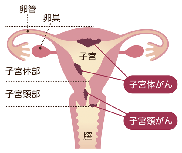 子宮がん